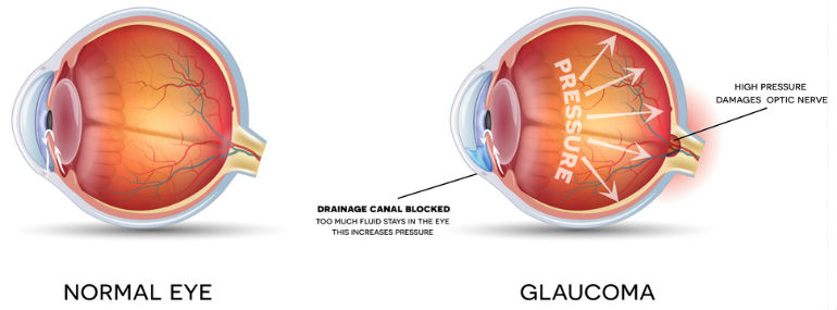 Glaucoma